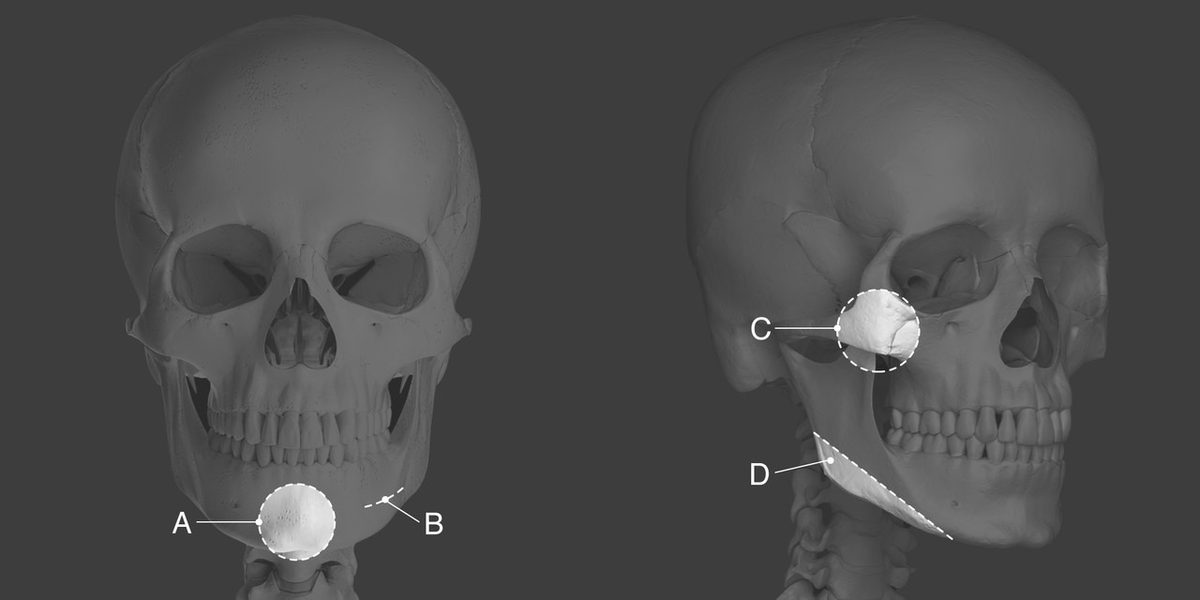 두개골 3D 모델 정면·측면. 정면에 턱끝(A)과 하악각(B), 측면에 광대뼈(C)와 하악각(D) 위치 표시