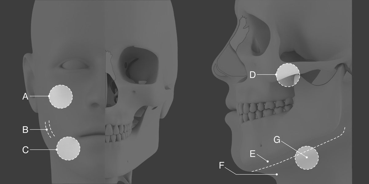 얼굴 3D 모델 정면·측면. 정면에 볼(A)·처짐 라인(B)·연조직(C), 측면에 턱 위(D)·처진 턱(E,F)·목 지방(G) 위치 표시